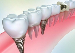 Если Вы потеряли зуб... О способах протезирования